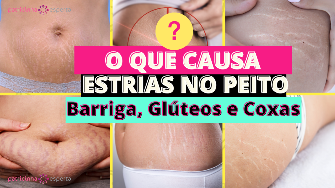 O Que Causa ESTRIAS no Peito Barriga Glúteos e Coxas julho 2021