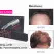 Hair Pro Laser resultados 105x105 - Hair Laser e Hair Pro Laser - acelere o crescimento de seus cabelos