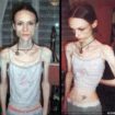 anorexia 105x105 - Anorexia Nervosa