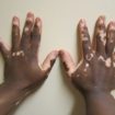 vitiligo 620 105x105 - Doença marcada pelo preconceito