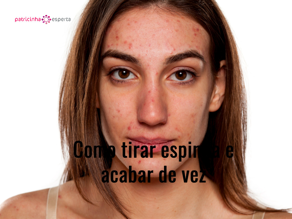 problematic skin picture id514057934 - Como Tirar Espinha e Acabar De Vez
