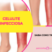 Celulite infecciosa 1 105x105 - Celulite infecciosa - Saiba como tratar
