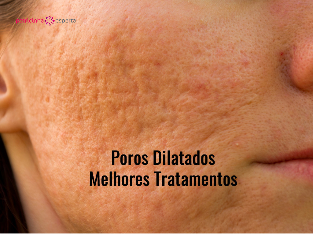 acne scars picture id179598340 - Poros Dilatados - Melhores Tratamentos