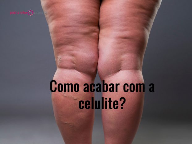 varicose veins closeup fat female cellulite legs picture id849084986 621x466 - Celulite Nas Pernas Tratamentos! ✅ O Guia Completo