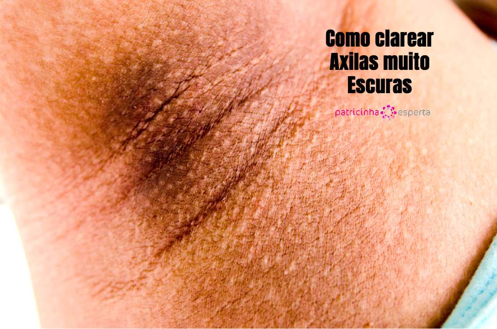 closeup black armpit pregnancy women effect picture id546193190 - Como Clarear Axilas Escuras?