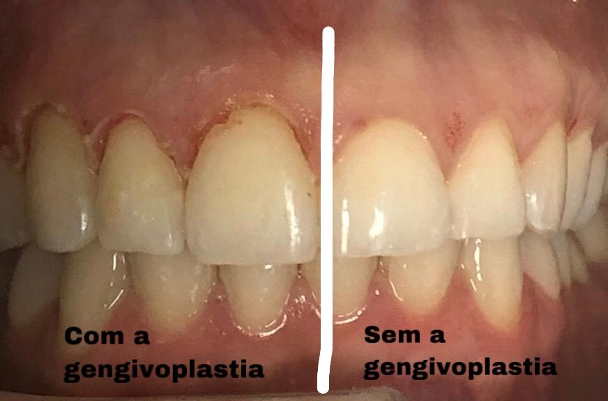 Gengivoplastia antes e depois